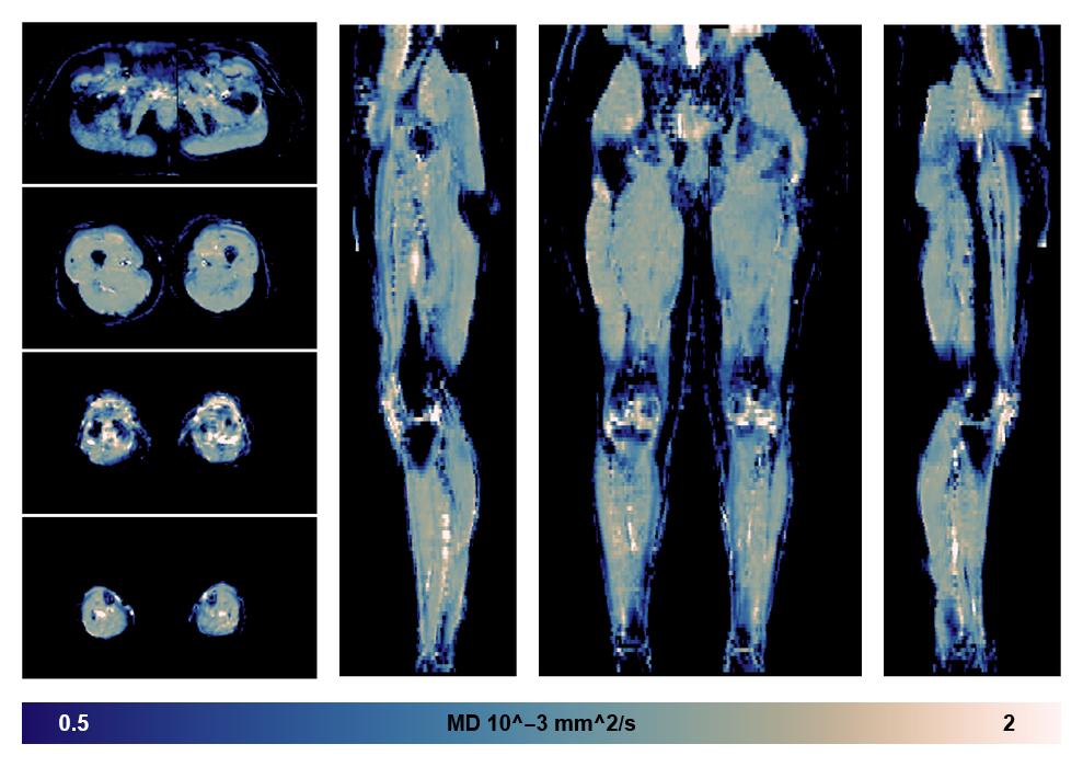 IVIM corrected whole leg muscle mean diffusivity obtained from diffusion tensor imaging.