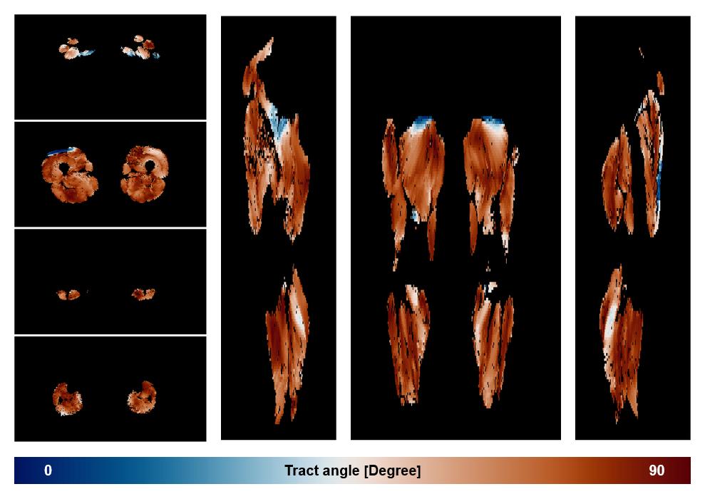 Muscle fiber tract angle map based on whole leg DTI based fiber tractography.