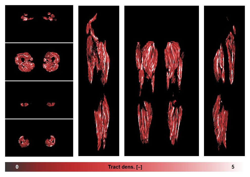 Muscle fiber tract density map based on whole leg DTI based fiber tractography.