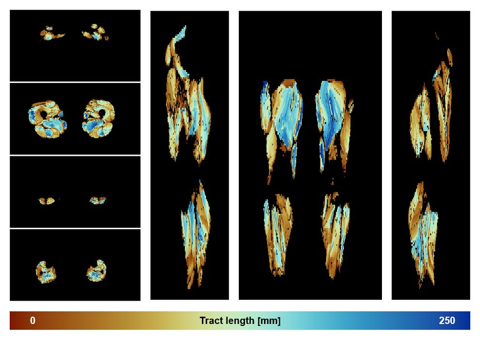 Muscle fiber tract length map based on whole leg DTI based fiber tractography.