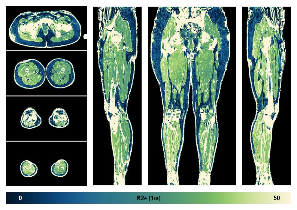 The R2 star relaxation time of the lower extremity obtained from the dixon reconstruction for muscle water fat quantification.