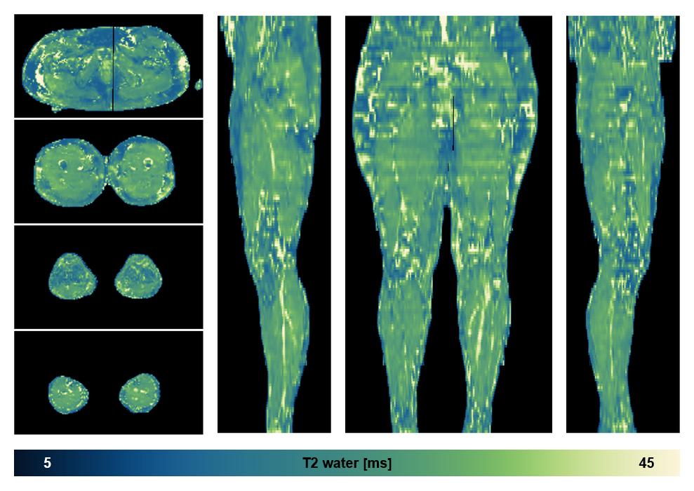 The water only T2 relaxation time of the lower extremity obtained from multi echo spin echo t2 mapping with EPG based reconstruction.