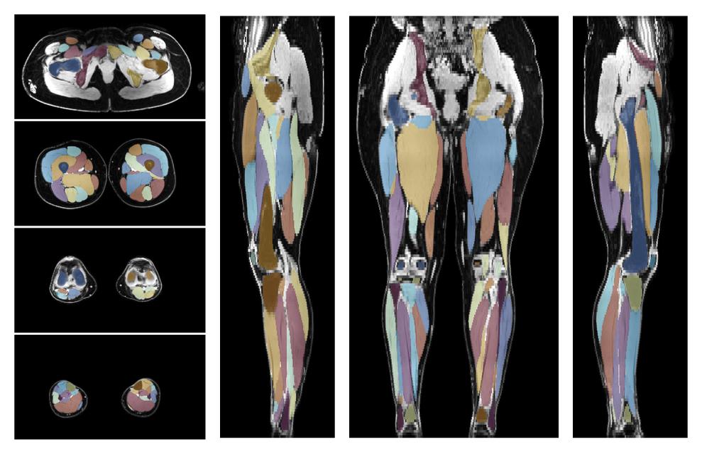 Overlay of automated muscle segmentation labels on dixon water image.