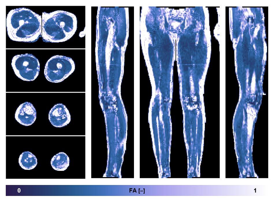 IVIM corrected whole leg muscle fractional anisotropy obtained from diffusion tensor imaging.