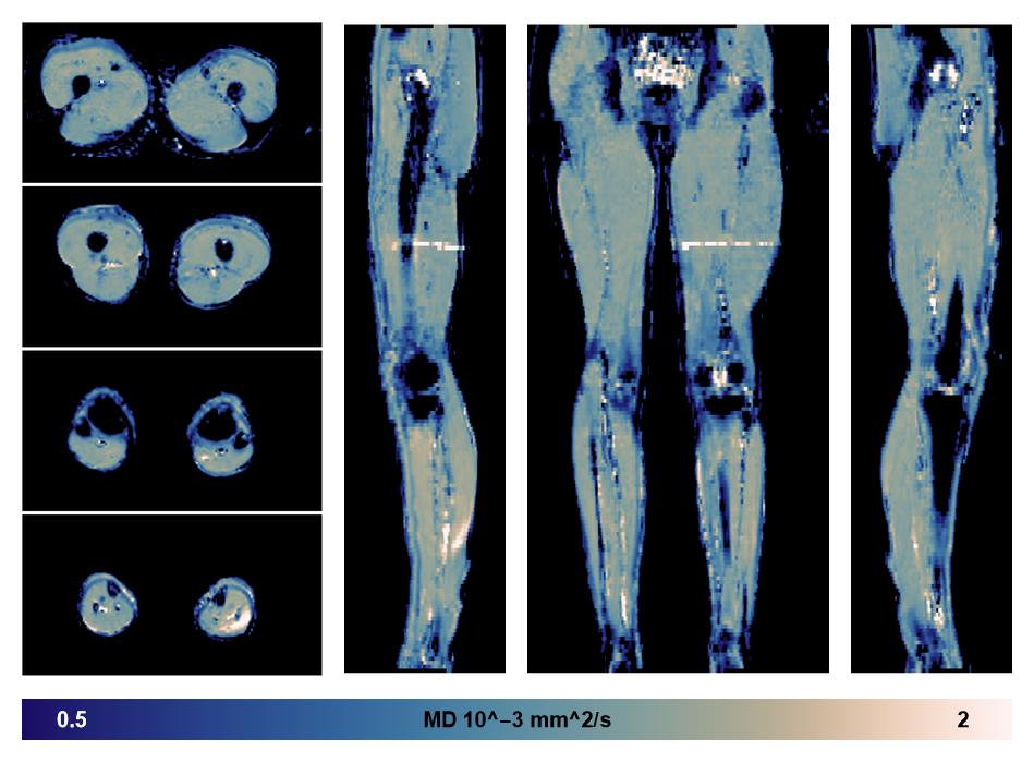 IVIM corrected whole leg muscle mean diffusivity obtained from diffusion tensor imaging.