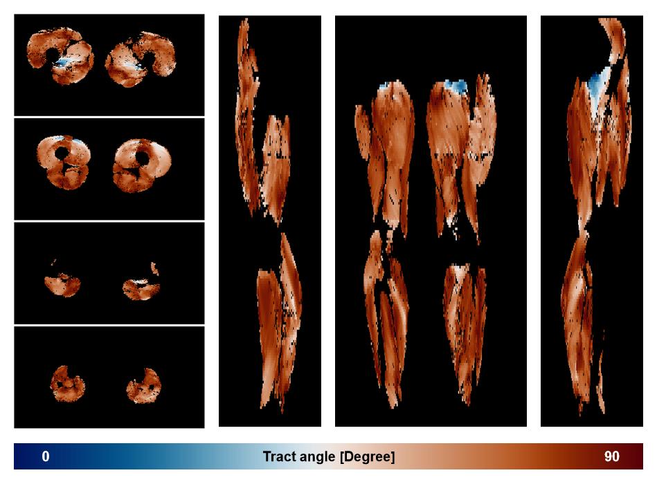 Muscle fiber tract angle map based on whole leg DTI based fiber tractography.