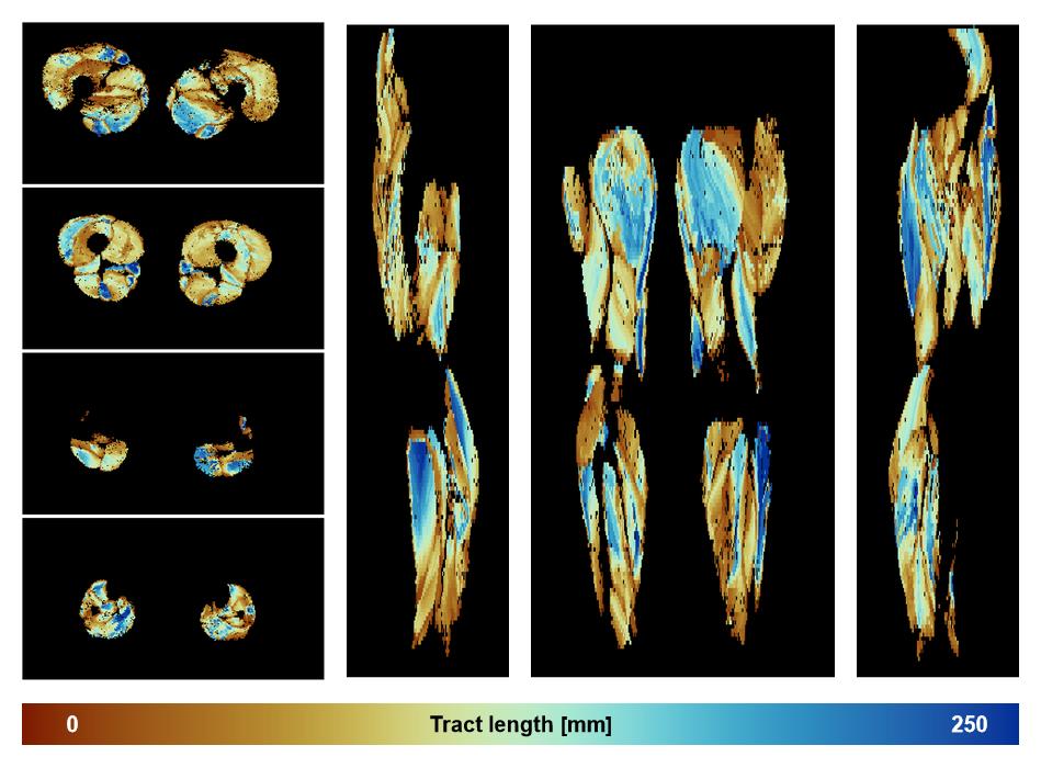 Muscle fiber tract length map based on whole leg DTI based fiber tractography.