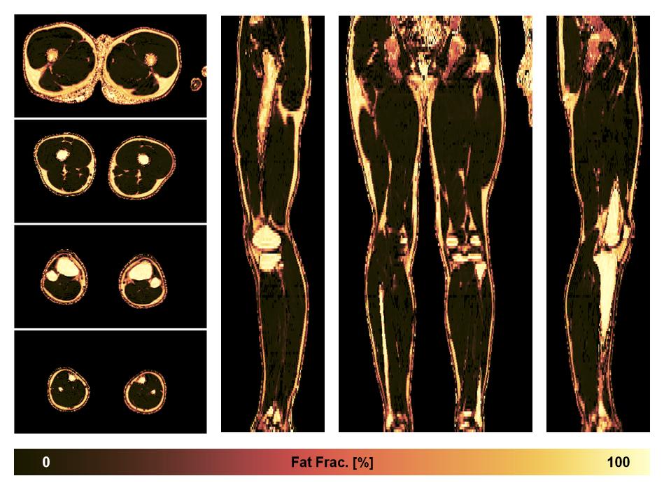 The fat fraction of the lower extremity obtained from the dixon reconstruction for muscle water fat quantification.
