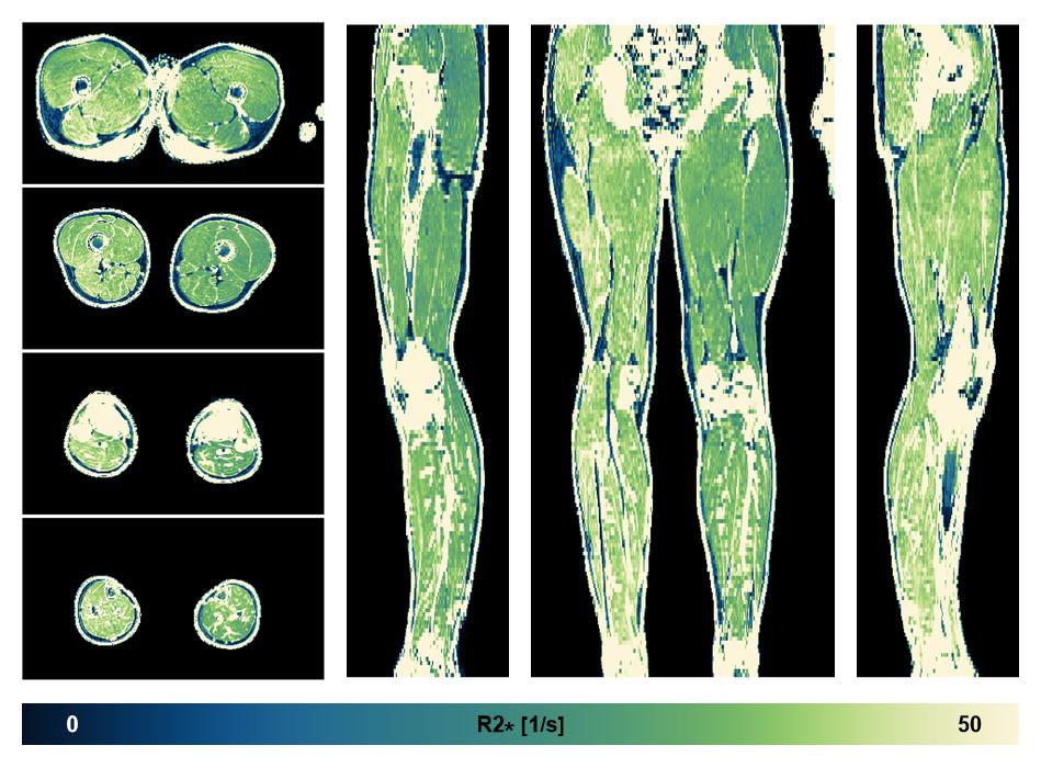 The R2 star relaxation time of the lower extremity obtained from the dixon reconstruction for muscle water fat quantification.