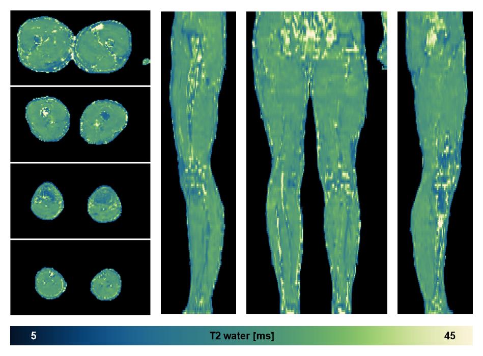 The water only T2 relaxation time of the lower extremity obtained from multi echo spin echo t2 mapping with EPG based reconstruction.