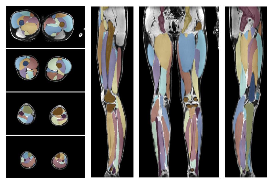 Overlay of automated muscle segmentation labels on dixon water image.