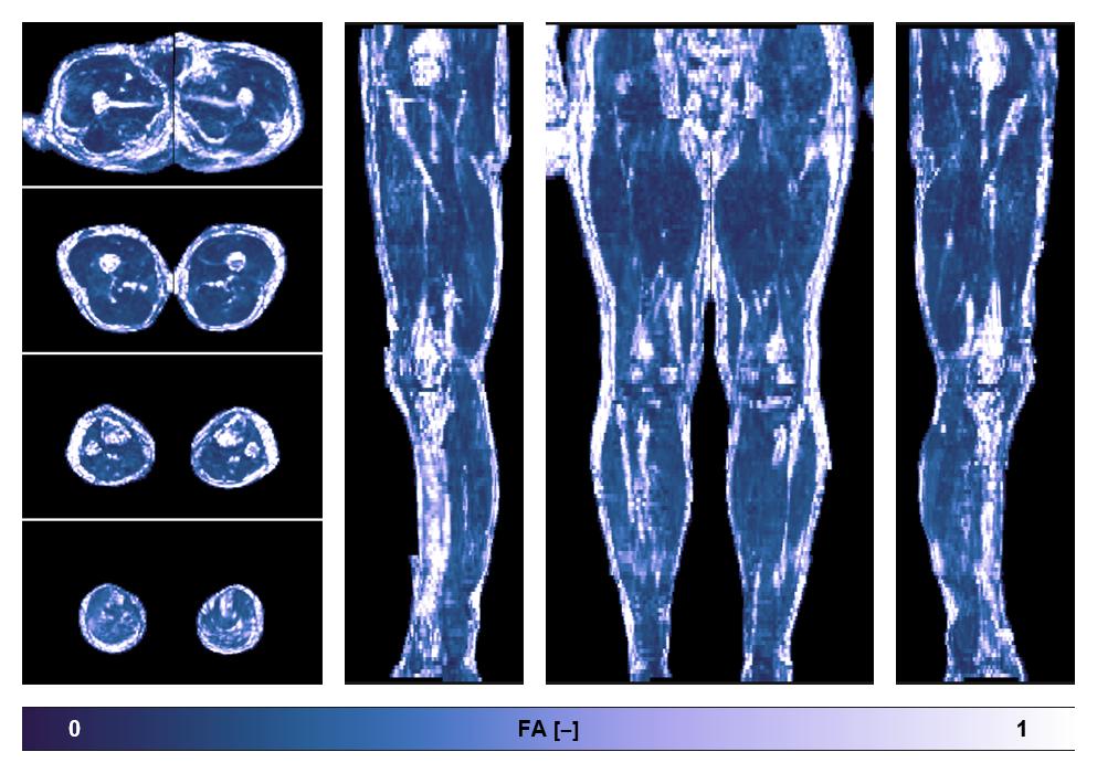 IVIM corrected whole leg muscle fractional anisotropy obtained from diffusion tensor imaging.