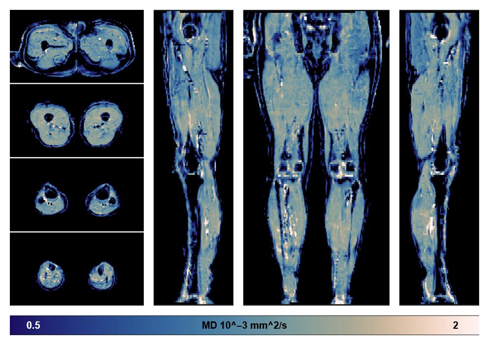 IVIM corrected whole leg muscle mean diffusivity obtained from diffusion tensor imaging.
