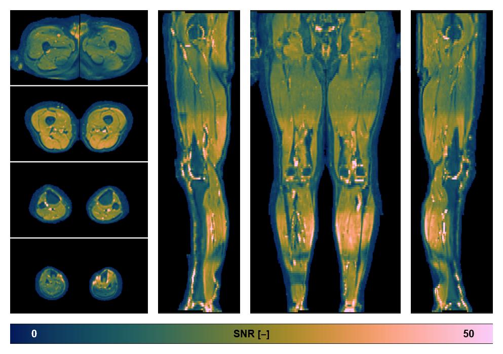 SNR distribution of the unweighted diffusion data.