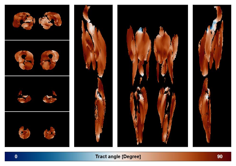 Muscle fiber tract angle map based on whole leg DTI based fiber tractography.