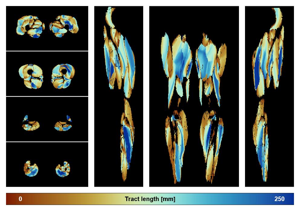 Muscle fiber tract length map based on whole leg DTI based fiber tractography.