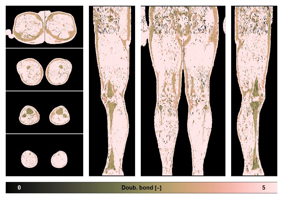 Number of double bonds in subcutanious fat.