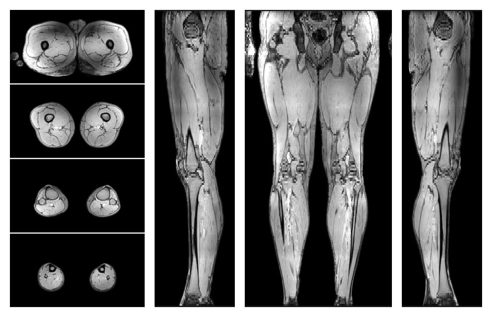 The out-phase image of the dixon reconstruction for water fat quantification.