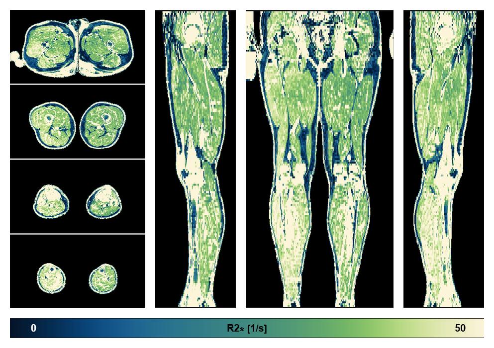 The R2 star relaxation time of the lower extremity obtained from the dixon reconstruction for muscle water fat quantification.