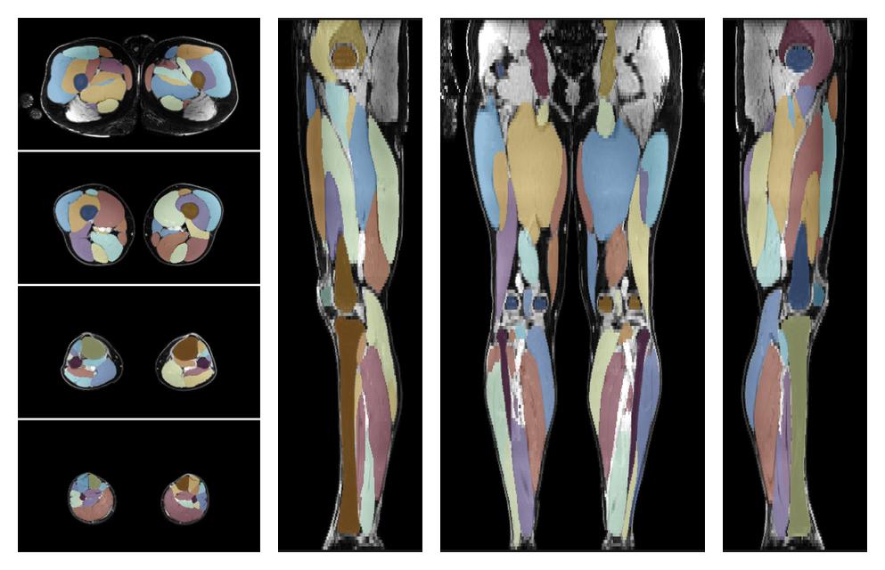 Overlay of automated muscle segmentation labels on dixon water image.