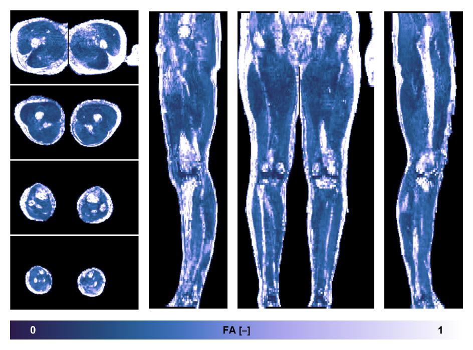 IVIM corrected whole leg muscle fractional anisotropy obtained from diffusion tensor imaging.