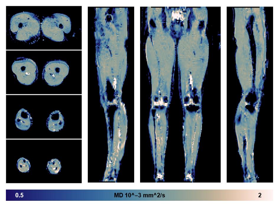 IVIM corrected whole leg muscle mean diffusivity obtained from diffusion tensor imaging.