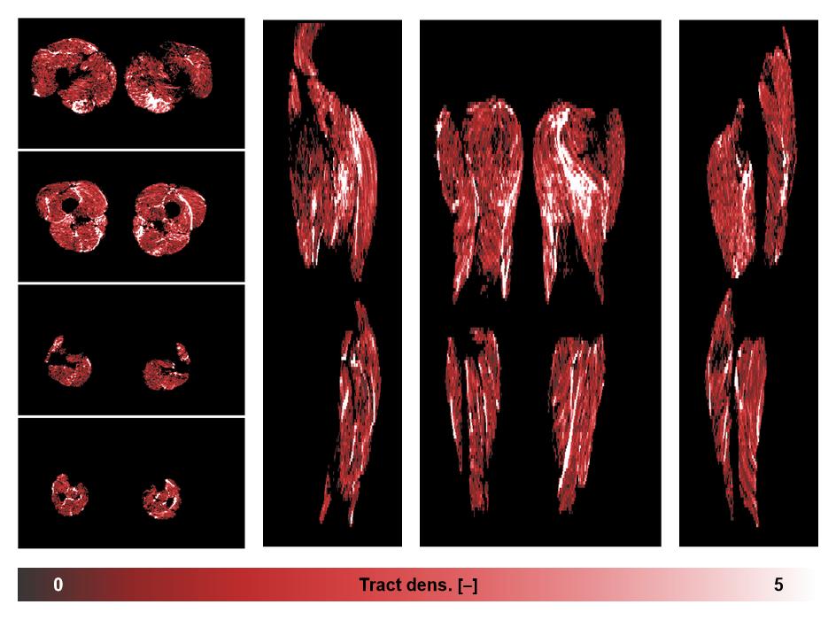 Muscle fiber tract density map based on whole leg DTI based fiber tractography.
