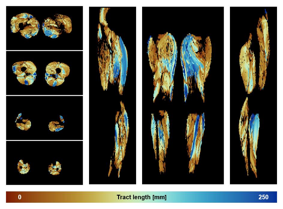 Muscle fiber tract length map based on whole leg DTI based fiber tractography.