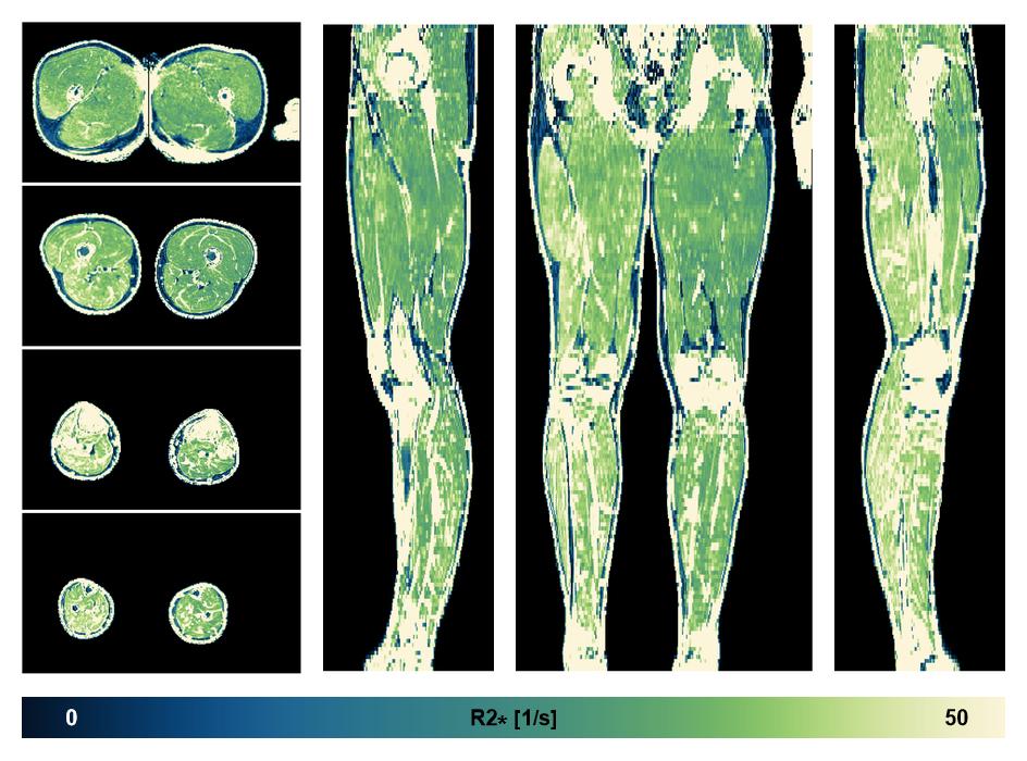 The R2 star relaxation time of the lower extremity obtained from the dixon reconstruction for muscle water fat quantification.