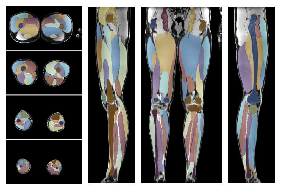 Overlay of automated muscle segmentation labels on dixon water image.