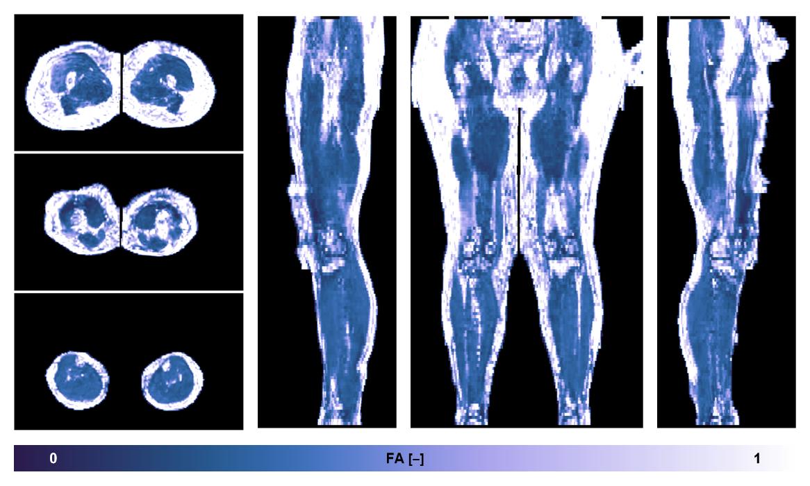 IVIM corrected whole leg muscle fractional anisotropy obtained from diffusion tensor imaging.