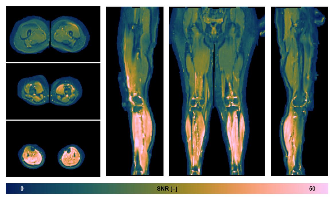 SNR distribution of the unweighted diffusion data.