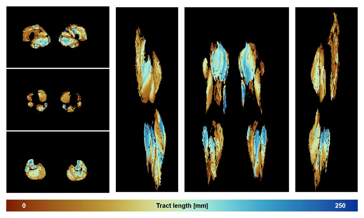 Muscle fiber tract length map based on whole leg DTI based fiber tractography.