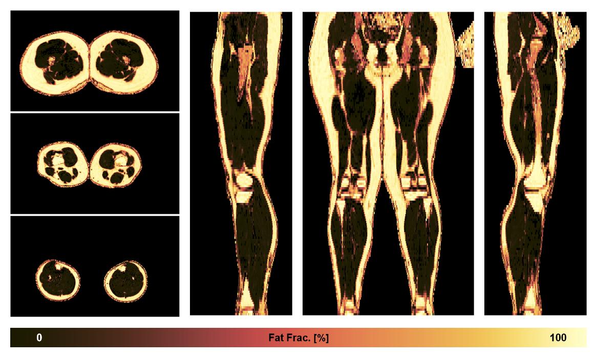 The fat fraction of the lower extremity obtained from the dixon reconstruction for muscle water fat quantification.