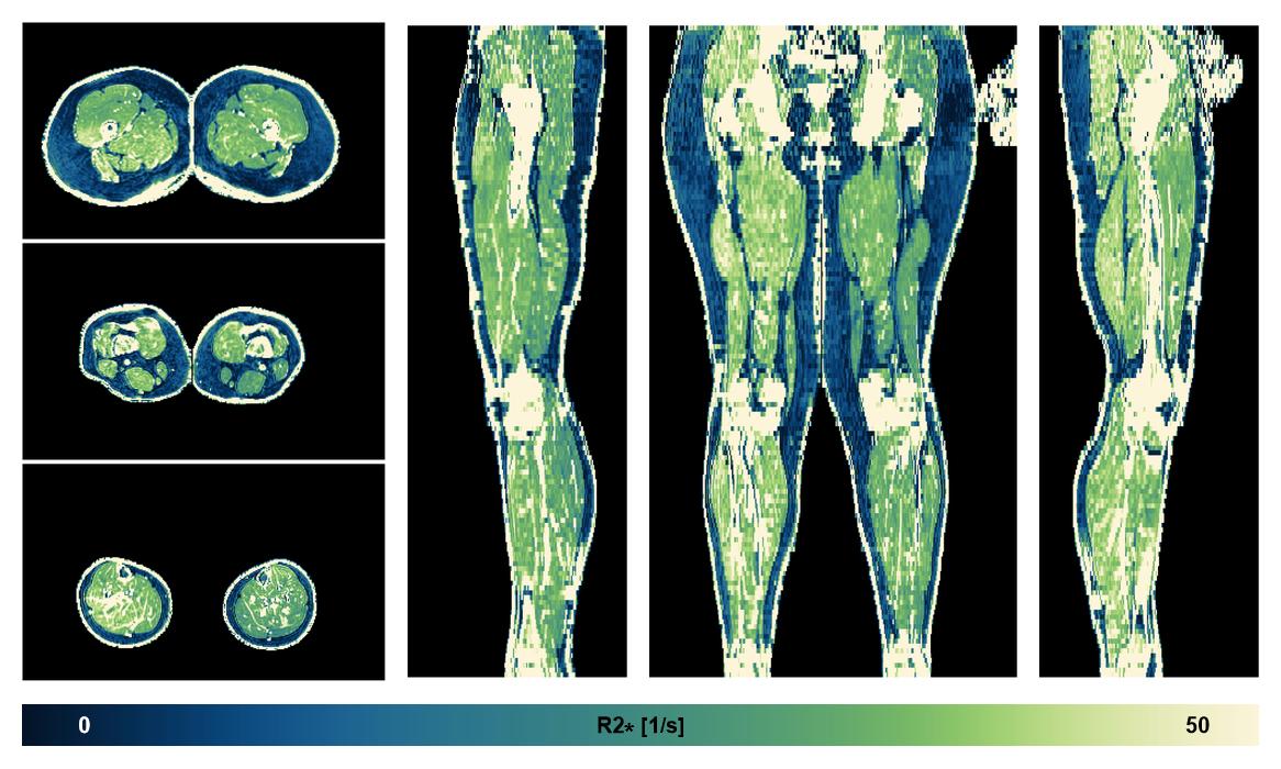 The R2 star relaxation time of the lower extremity obtained from the dixon reconstruction for muscle water fat quantification.