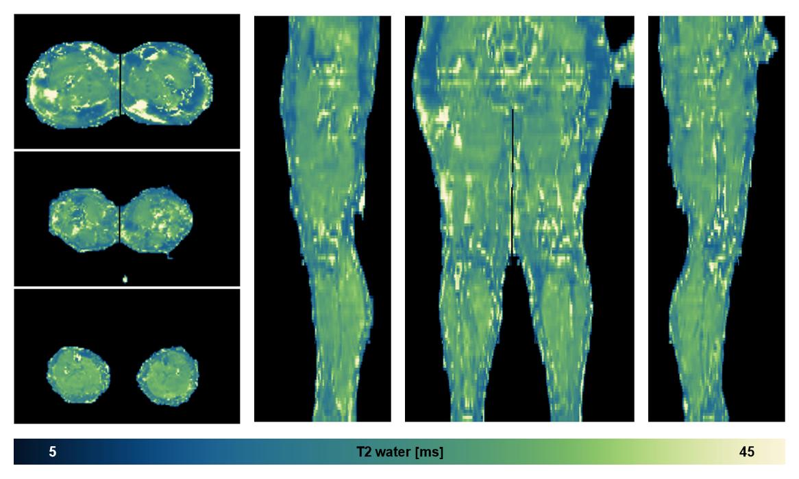 The water only T2 relaxation time of the lower extremity obtained from multi echo spin echo t2 mapping with EPG based reconstruction.