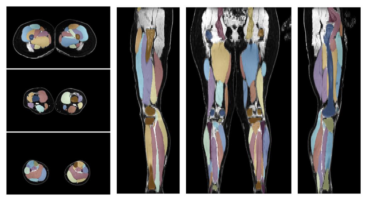 Overlay of automated muscle segmentation labels on dixon water image.