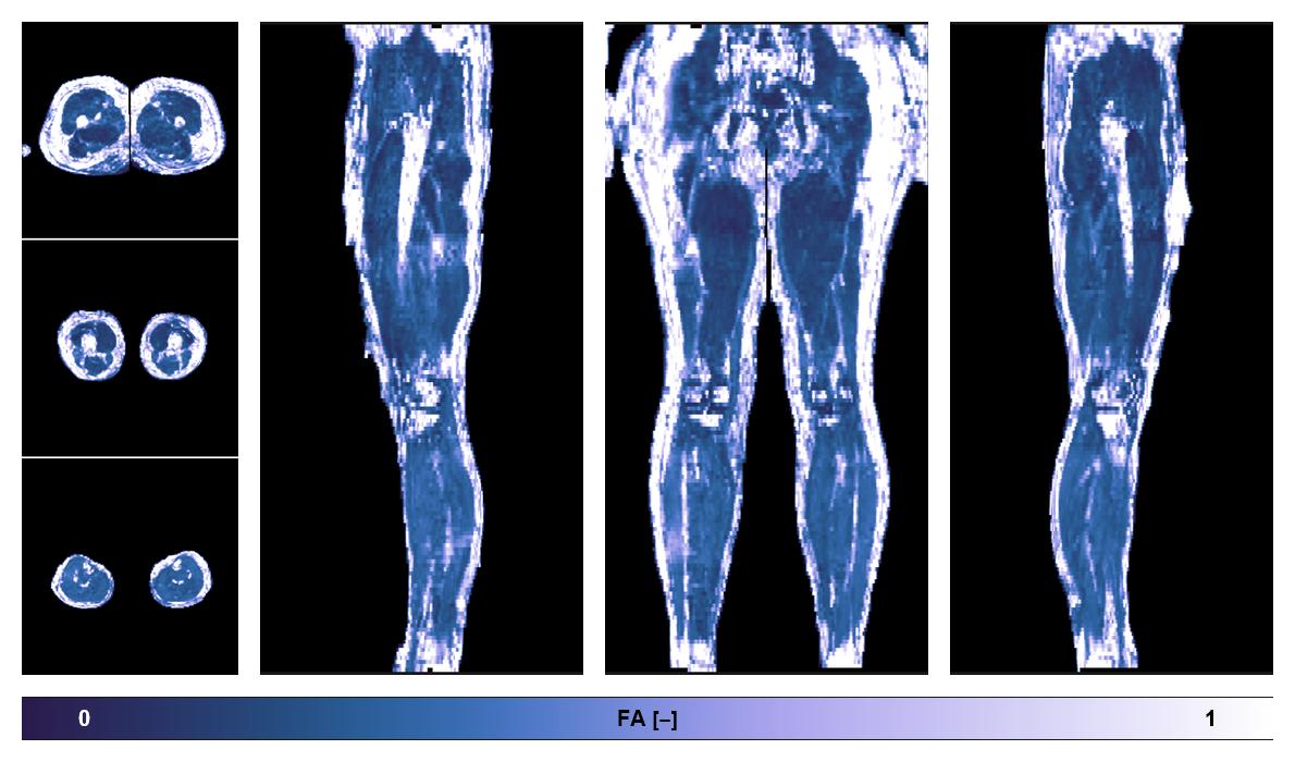 IVIM corrected whole leg muscle fractional anisotropy obtained from diffusion tensor imaging.