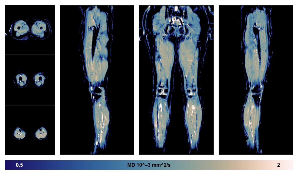IVIM corrected whole leg muscle mean diffusivity obtained from diffusion tensor imaging.