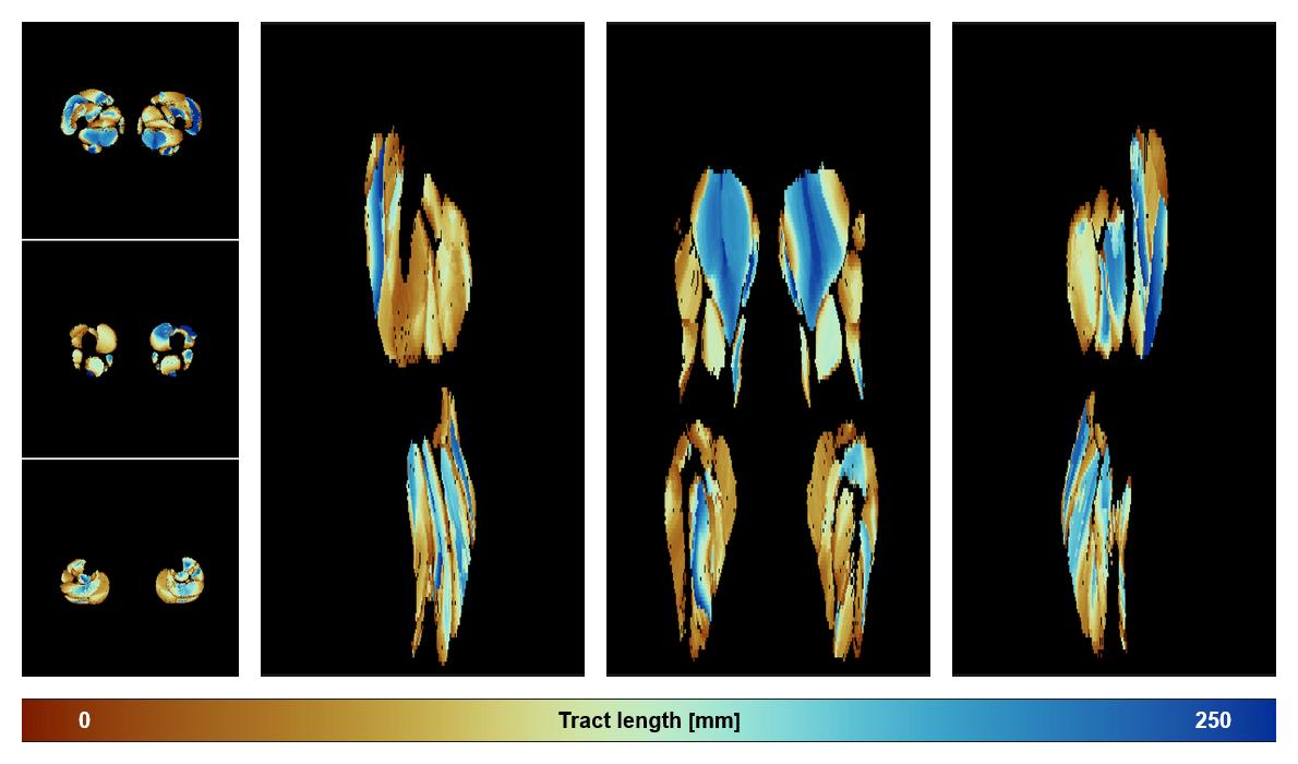 Muscle fiber tract length map based on whole leg DTI based fiber tractography.