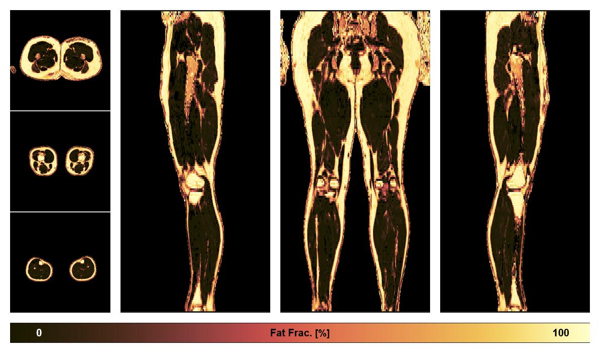 The fat fraction of the lower extremity obtained from the dixon reconstruction for muscle water fat quantification.