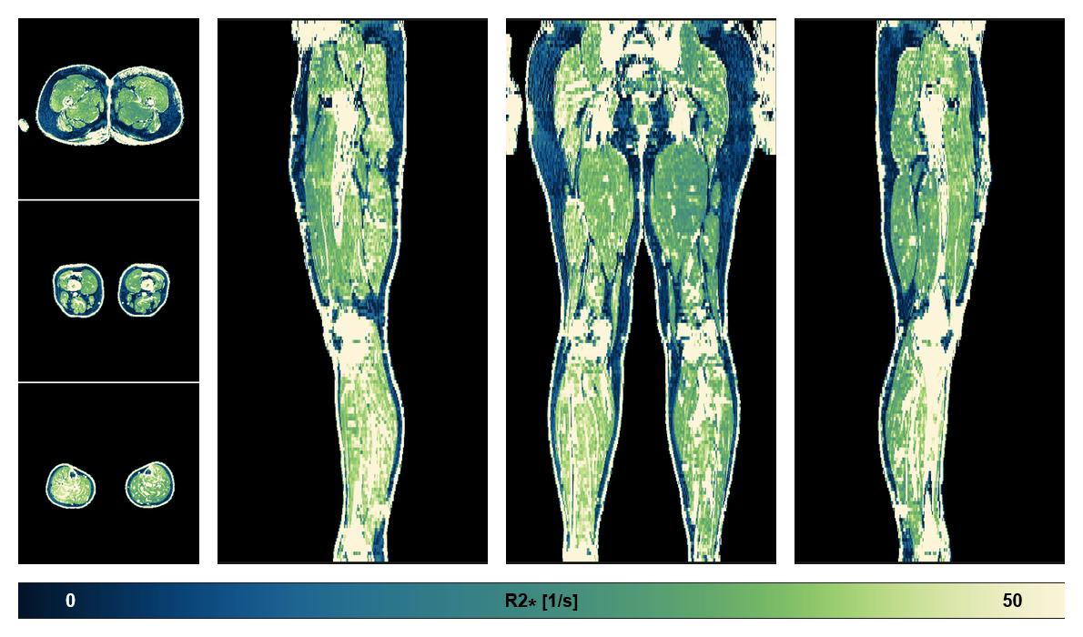 The R2 star relaxation time of the lower extremity obtained from the dixon reconstruction for muscle water fat quantification.