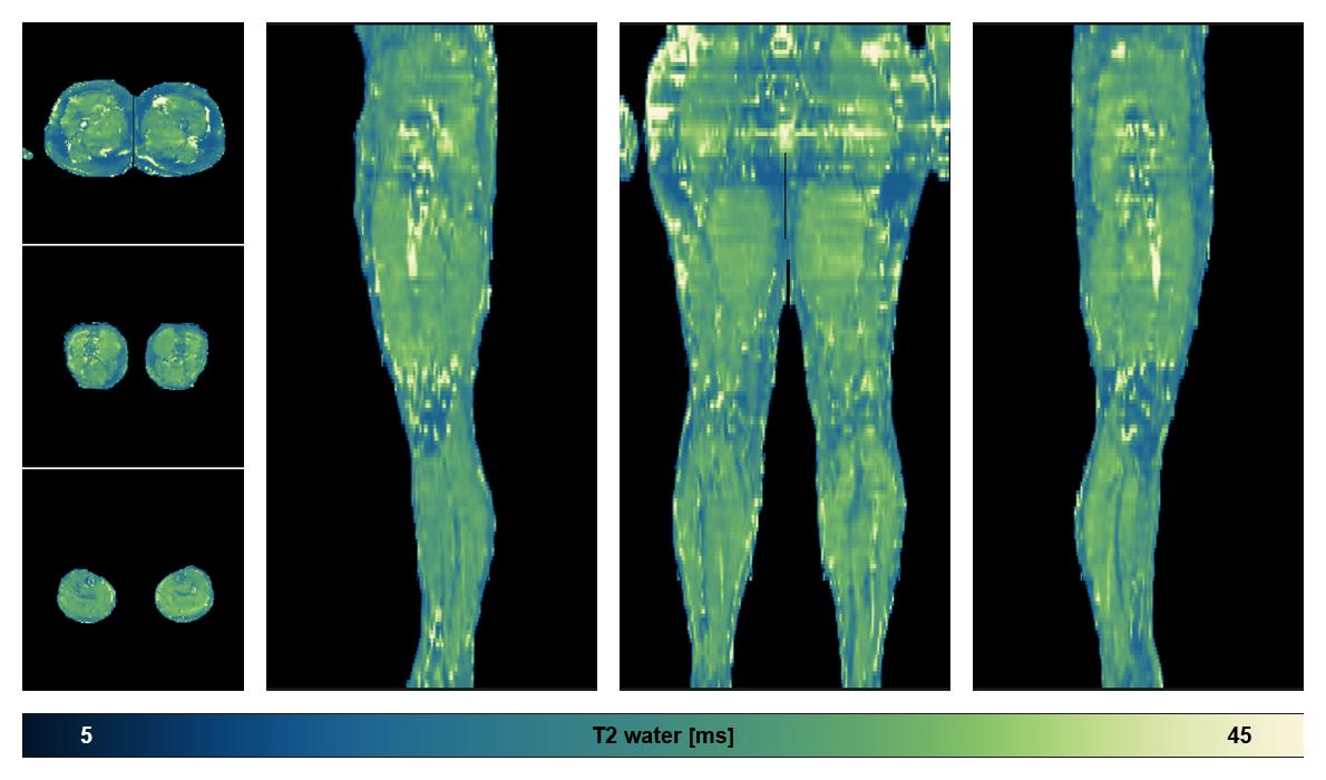 The water only T2 relaxation time of the lower extremity obtained from multi echo spin echo t2 mapping with EPG based reconstruction.