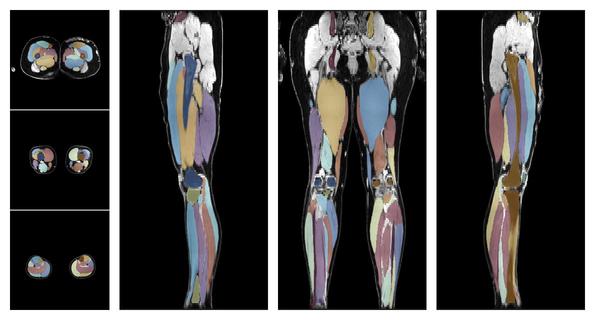 Overlay of automated muscle segmentation labels on dixon water image.