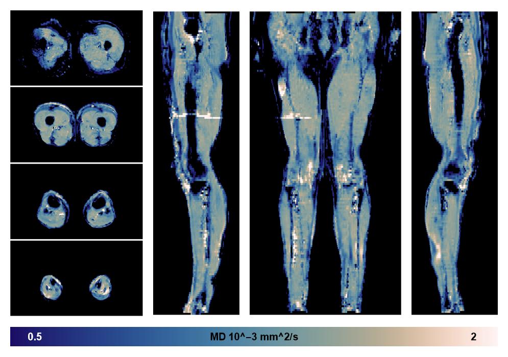 IVIM corrected whole leg muscle mean diffusivity obtained from diffusion tensor imaging.
