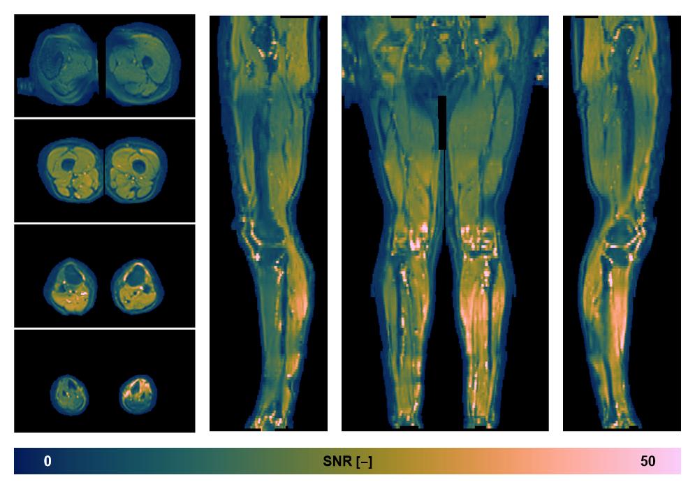 SNR distribution of the unweighted diffusion data.