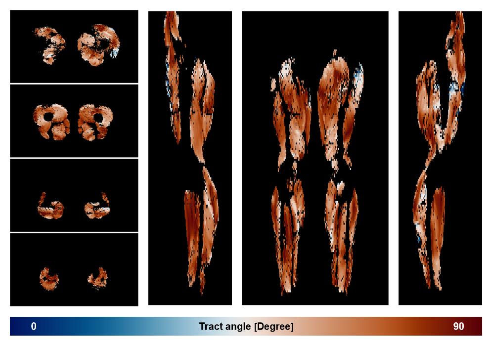 Muscle fiber tract angle map based on whole leg DTI based fiber tractography.