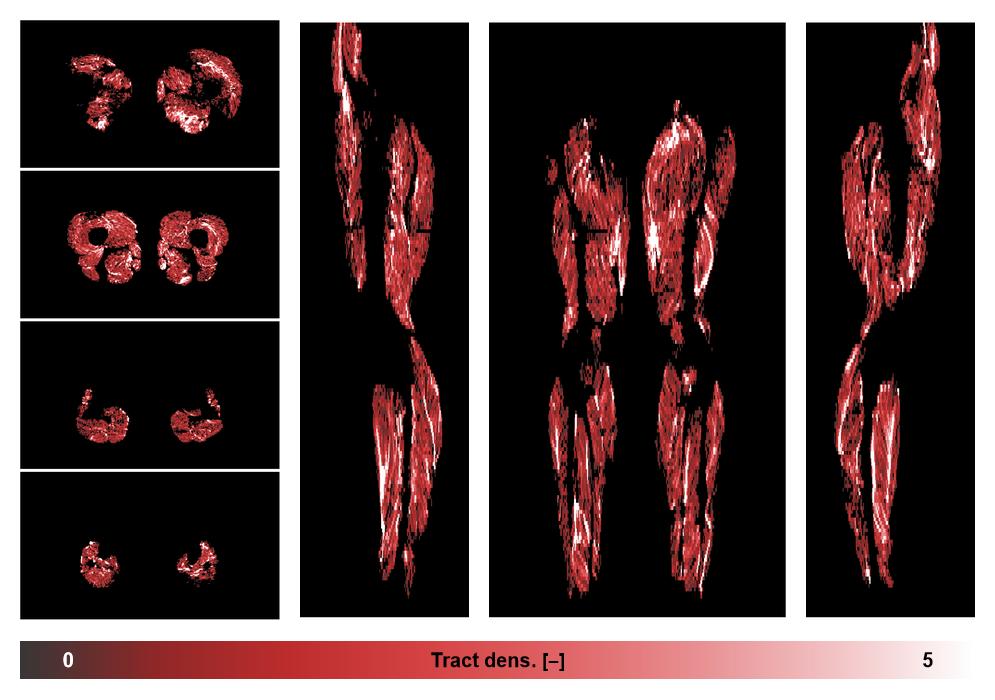 Muscle fiber tract density map based on whole leg DTI based fiber tractography.