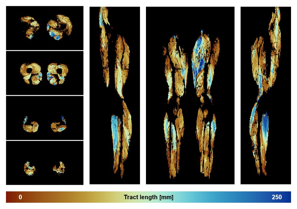 Muscle fiber tract length map based on whole leg DTI based fiber tractography.