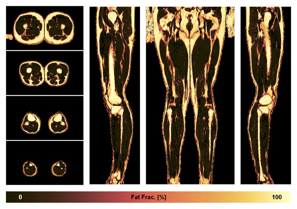 The fat fraction of the lower extremity obtained from the dixon reconstruction for muscle water fat quantification.